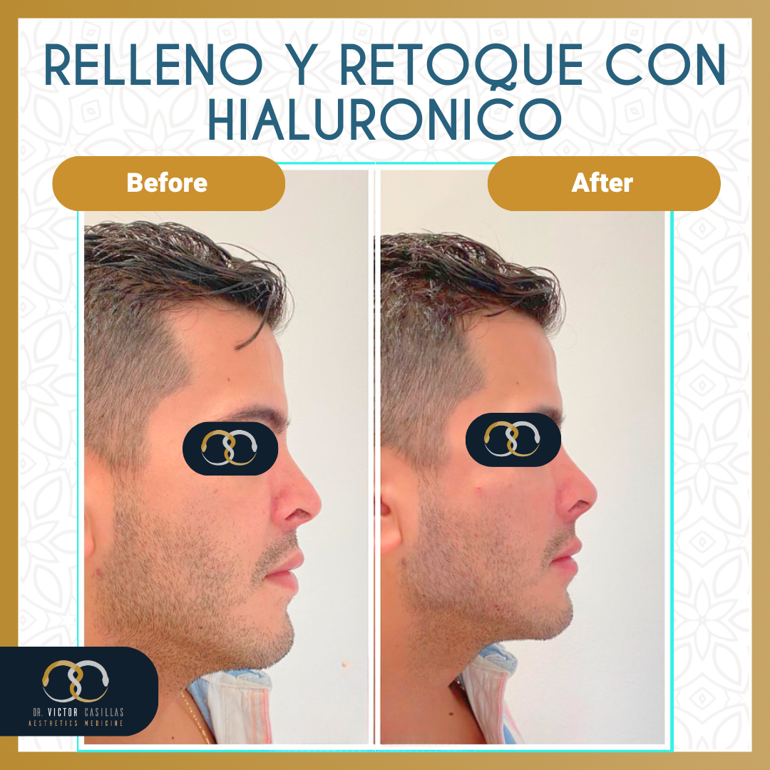 DR.VC - Template b&a relleno